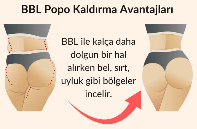 Antalya BBL popo kaldırma avantajları