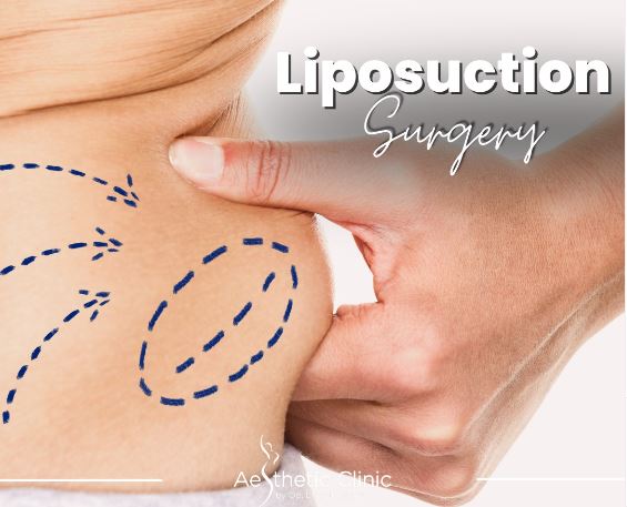 What is liposuction in Turkey?